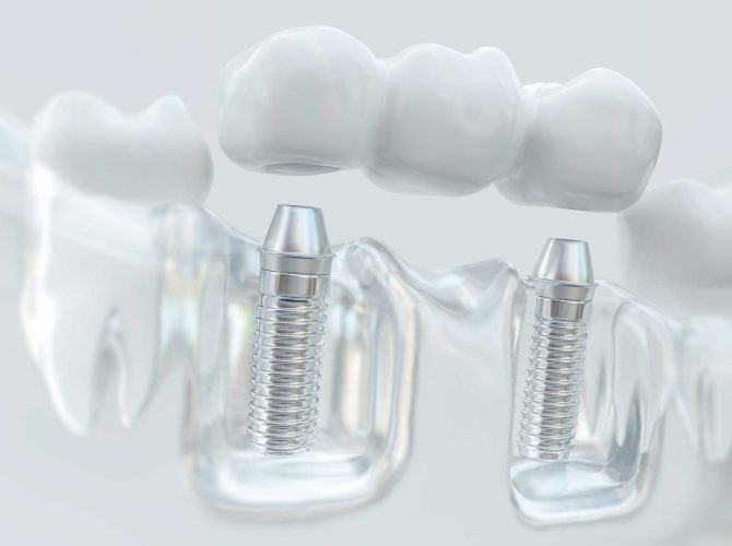 Dental Implants Northampton