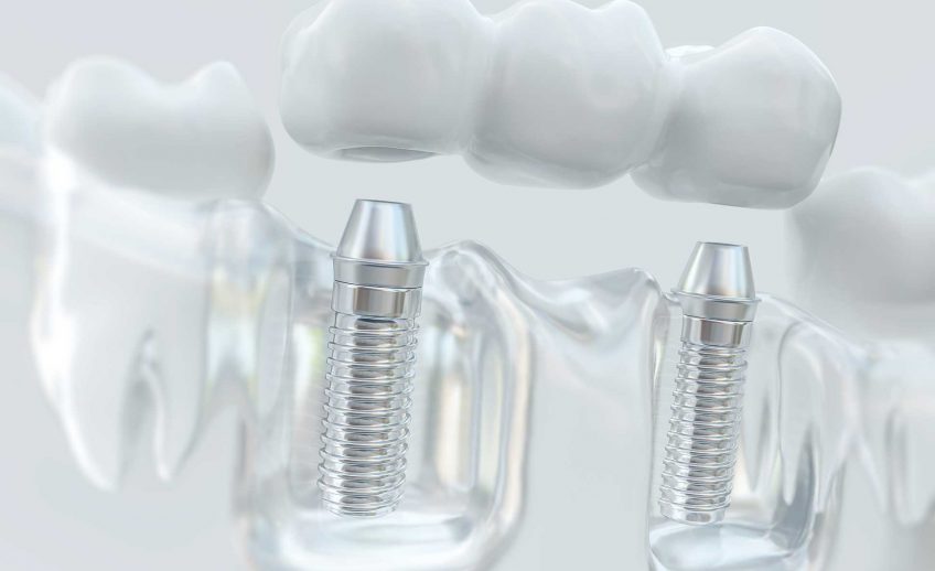 Dental Implants Northampton