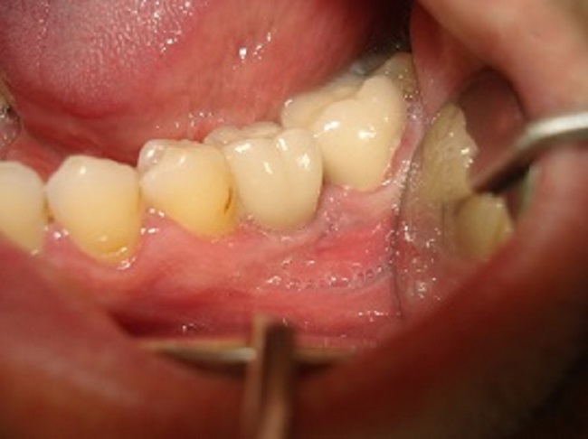 2- Implant After