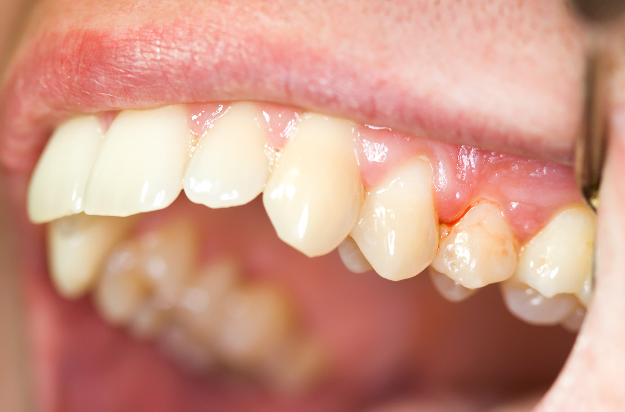 teeth gums bleeding brushing cause gingivitis dental dentist health beauty smile